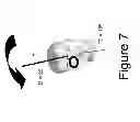 Fig. 08 - Quantifying ocular counter roll