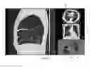 Fig. 06 - Visualization and characterization of pulmonary lobar fissures
