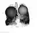 Fig. 08 - Visualization and characterization of pulmonary lobar fissures