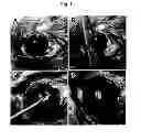 Fig. 02 - Method for treating vascular-related disease