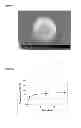 Fig. 02 - Use of epidermal growth factor for the morphofunctional restoration of peripheral nerves in diabetic neuropathy