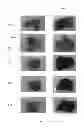 Fig. 22 - HEMOGLOBIN-BASED OXYGEN CARRIER-CONTAINING PHARMACEUTICAL COMPOSITION FOR CANCER TARGETING TREATMENT AND PREVENTION OF CANCER RECURRENCE