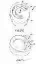Fig. 40 - Interdental cleaner using water supply