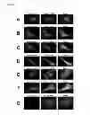Fig. 03 - Genes causing hereditary kidney disease or malformation of the urinary tract