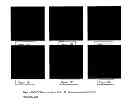 Fig. 14 - Fetal aneuploidy detection by sequencing