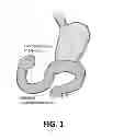 Fig. 02 - METHOD OF ADMINISTERING ETHANOLAMINE 9-OCTADECANOIC ACID VIA INJECTION TO THE STOMACH OF A HUMAN