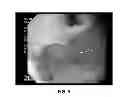 Fig. 04 - METHOD OF ADMINISTERING ETHANOLAMINE 9-OCTADECANOIC ACID VIA INJECTION TO THE STOMACH OF A HUMAN