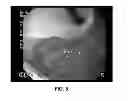 Fig. 06 - METHOD OF ADMINISTERING ETHANOLAMINE 9-OCTADECANOIC ACID VIA INJECTION TO THE STOMACH OF A HUMAN