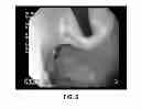 Fig. 07 - METHOD OF ADMINISTERING ETHANOLAMINE 9-OCTADECANOIC ACID VIA INJECTION TO THE STOMACH OF A HUMAN