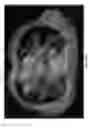 Fig. 49 - IMPLEMENTATION AND EXPERIMENTAL RESULTS OF REAL-TIME 4D TUMOR TRACKING USING MULTI-LEAF COLLIMATOR (MLC), AND/OR MLC-CARRIAGE (MLC-BANK), AND/OR TREATMENT TABLE (COUCH)
