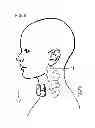 Fig. 08 - Methods and devices for treating primary headache