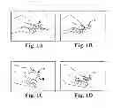 Fig. 02 - Adjustable pessary device and method