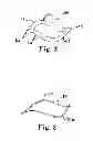 Fig. 03 - Adjustable pessary device and method