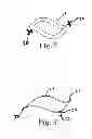 Fig. 04 - Adjustable pessary device and method