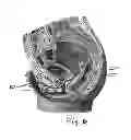 Fig. 05 - Adjustable pessary device and method