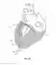 Fig. 08 - Cardiac treatment system and method