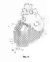 Fig. 08 - Cardiac treatment system and method