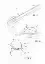 Fig. 02 - GASTRIC BAND