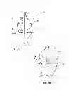 Fig. 06 - GASTRIC BAND