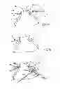 Fig. 07 - GASTRIC BAND
