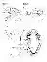 Fig. 02 - DEVICE FOR CORRECTING SUNKEN CHEEKS