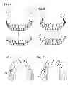Fig. 03 - DEVICE FOR CORRECTING SUNKEN CHEEKS
