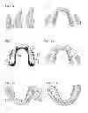 Fig. 04 - DEVICE FOR CORRECTING SUNKEN CHEEKS