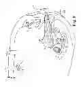 Fig. 11 - Vaginal manipulator with an adjustable length head