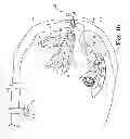 Fig. 12 - Vaginal manipulator with an adjustable length head