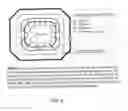 Fig. 03 - Image-Guided Radiotherapy For Internal Tumor Boost