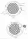 Fig. 06 - Image-Guided Radiotherapy For Internal Tumor Boost