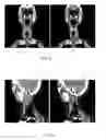Fig. 07 - Image-Guided Radiotherapy For Internal Tumor Boost