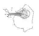 Fig. 01 - Balloon catheter and applicator with balloon catheter