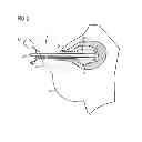 Fig. 03 - Balloon catheter and applicator with balloon catheter