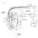Fig. 02 - Differentiating decompensation detection based on co-morbidities in heart failure