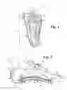 Fig. 02 - Disposable two-part orthotic foot support strap system and method