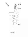 Fig. 11 - LAPAROSCOPIC DELIVERY  DEVICE
