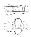 Fig. 05 - Balloon Catheter