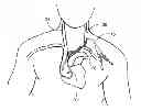 Fig. 01 - APPARATUS FOR LEFT-SIDE INSTALLATION OF TUNNELED VASCULAR CATHETERS