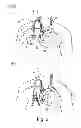 Fig. 03 - APPARATUS FOR LEFT-SIDE INSTALLATION OF TUNNELED VASCULAR CATHETERS