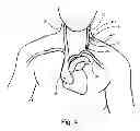 Fig. 05 - APPARATUS FOR LEFT-SIDE INSTALLATION OF TUNNELED VASCULAR CATHETERS