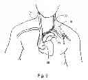 Fig. 06 - APPARATUS FOR LEFT-SIDE INSTALLATION OF TUNNELED VASCULAR CATHETERS