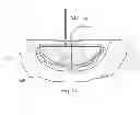 Fig. 24 - Wound treatment apparatus and method