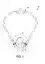 Fig. 02 - Irrigating cannula system and methods