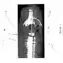 Fig. 07 - SIDE FIRING OPTICAL FIBER DEVICE FOR CONSISTENT, RAPID VAPORIZATION OF TISSUE AND EXTENDED LONGEVITY