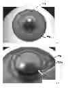 Fig. 04 - ANNULAR KERATOPIGMENTATION SYSTEMS AND METHODS OF VISION CORRECTION OF PRESBYOPIC EYES