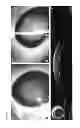 Fig. 19 - ANNULAR KERATOPIGMENTATION SYSTEMS AND METHODS OF VISION CORRECTION OF PRESBYOPIC EYES