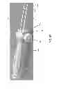 Fig. 07 - Devices and methods for fistula formation