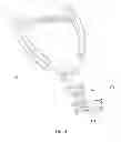 Fig. 28 - Orthopaedic plate and spreader apparatuses and methods