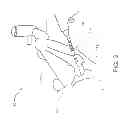 Fig. 03 - Method and apparatus for hip replacements